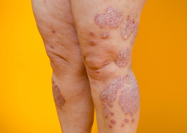 5 Ways To Treat Your Skin Allergies